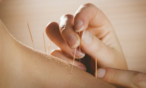 Acupuncture Treatment Cheyenne, WY